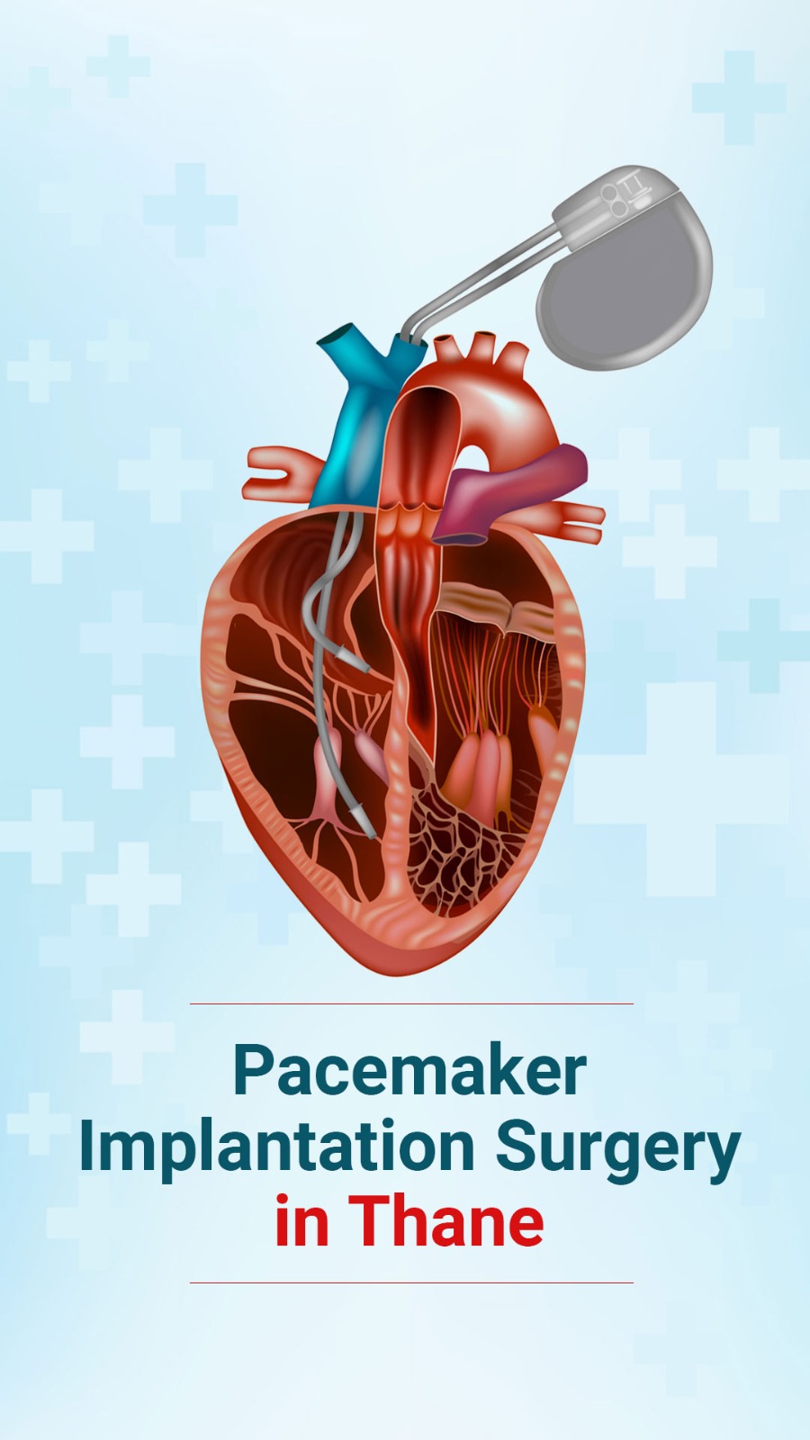 Pacemaker Implantation Surgery in Thane