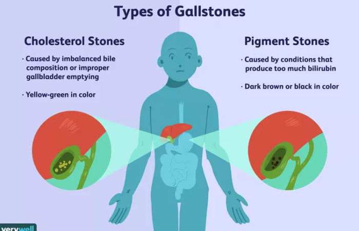 Gallstones Come In Two Primary Types
