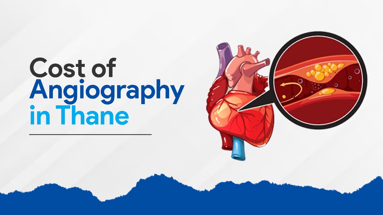 Cost of Angiography in thane